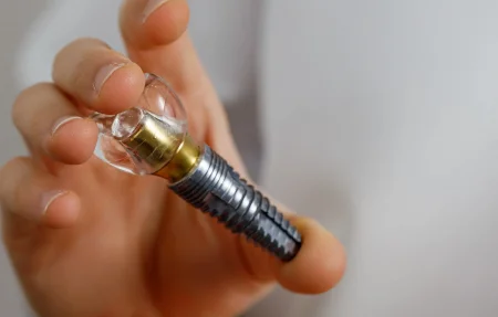 Имплантация зубов Имплантация зубов